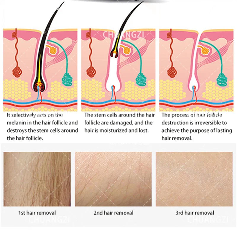 Máquina Laser Diodo 808nm 3 Comprimentos Onda - Depilação Rejuvenescimento Indolor Mulheres