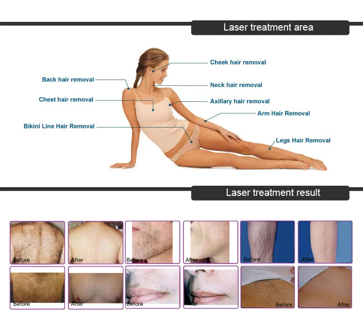 Máquina Laser Diodo Desktop Profissional Alta Qualidade - 3 Wavelengths Rejuvenescimento Depilação Indolor