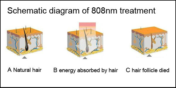Máquina Laser Diodo Desktop Profissional Alta Qualidade - 3 Wavelengths Rejuvenescimento Depilação Indolor
