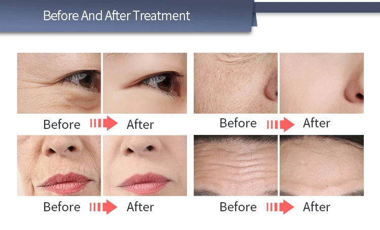 Máquina Profissional de Estimulação Elétrica Facial EMRF EMS RF Lifting Facial PEFACE Sculpt Pads Massageador Equipamento