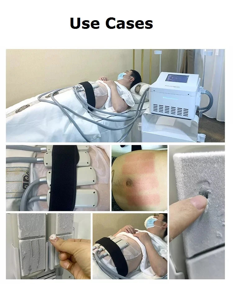 Máquina Criolipolise EMS Profissional - Equipamento Modelação Corporal Não-Invasivo com Congelamento de Gordura