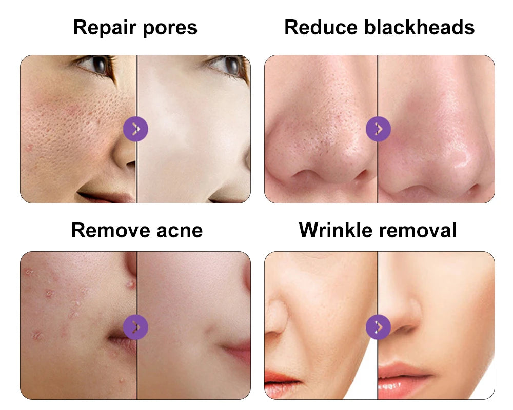 Máquina Hidrodermabrasão Facial H2O2 - Limpeza Profunda com Oxigénio e Peeling Aquático
