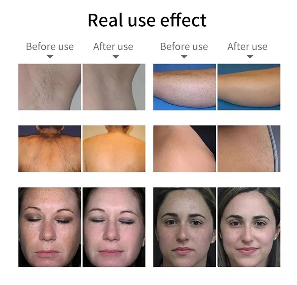 Máquina IPL Profissional Depilação Laser - Equipamento Salão Beleza Remoção Permanente Elight OPT Indolor