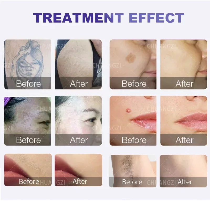 Máquina Laser Diodo Multifuncional 2 em 1 - Depilação e Remoção Tatuagens 3 Comprimentos Onda