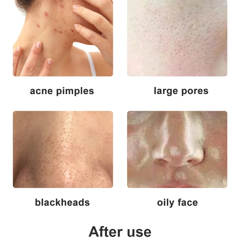 Máquina Microdermoabrasão Facial Beemyi - Pontas Diamante para Rejuvenescimento e Esfoliação