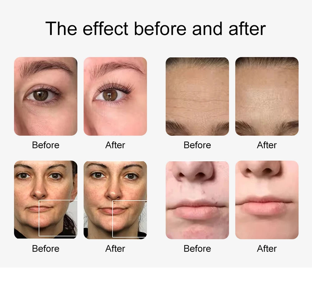 Máquina AOKO 10 em 1 Hidrodermabrasão - Peeling Aquático Ultrassom Oxigenação Facial