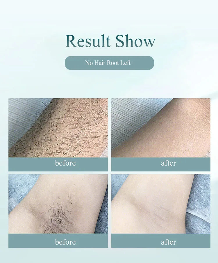 Depilador IPL Profissional Permanente - Remoção Pelos Corpo Inteiro Casa Mulheres 900.000 Flashes