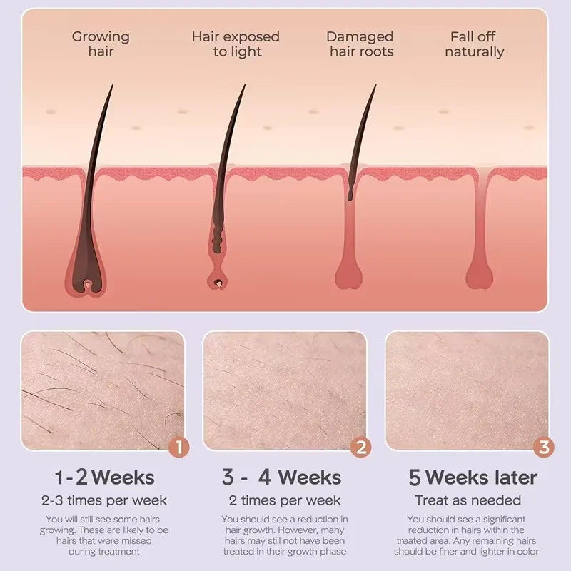 Depilador IPL Laser Feminino Profissional - Luz Pulsada Elétrico Rosto Corpo Biquíni 999.999 Flashes