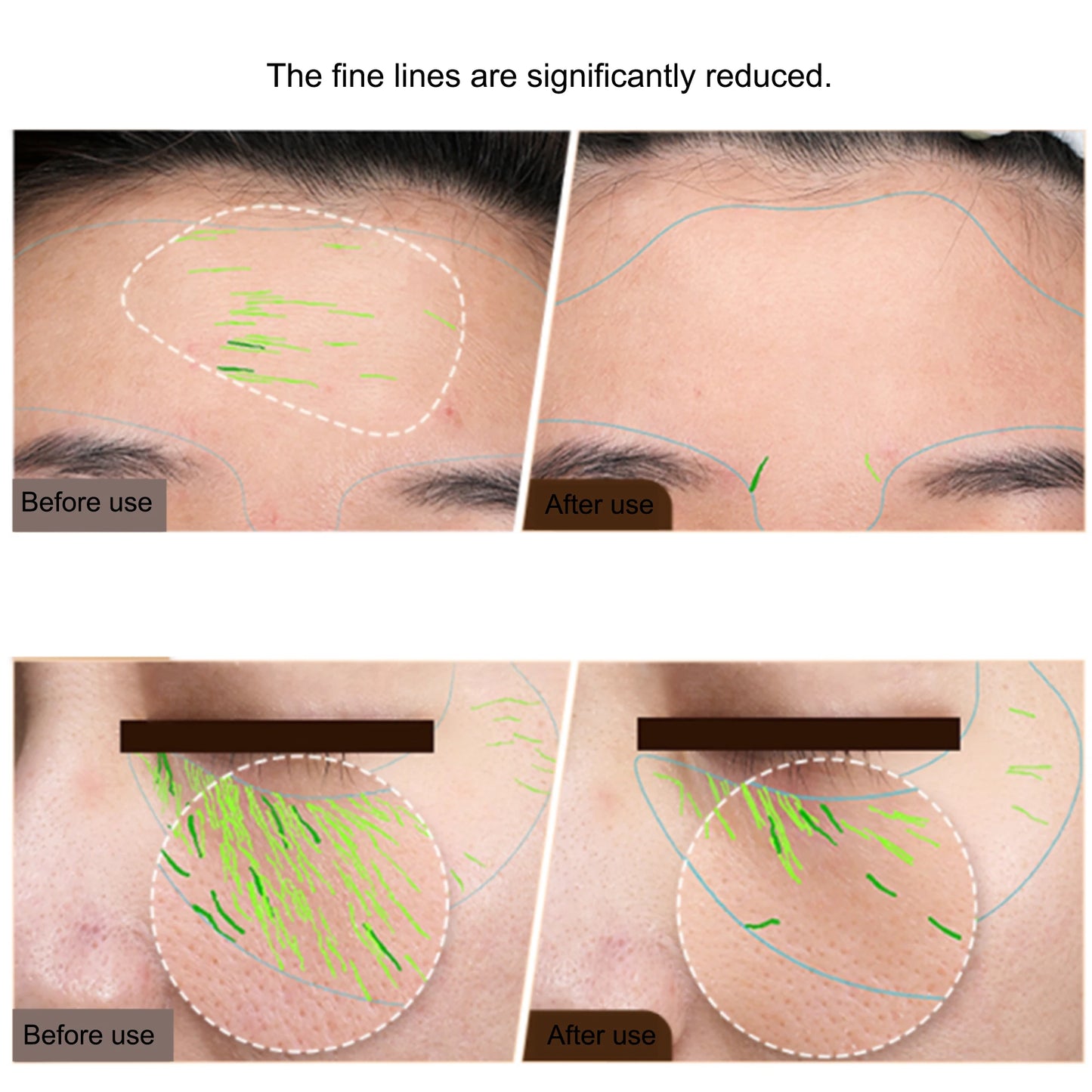 Dispositivo EMS Radiofrequência Corporal - Firmeza Facial e Corporal Anti-Envelhecimento