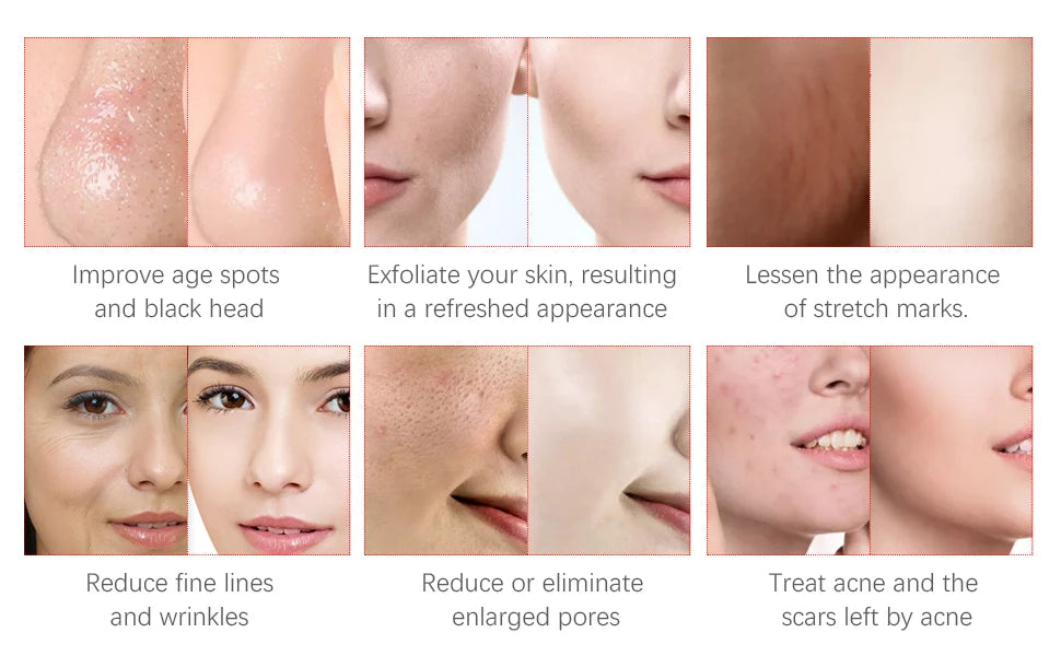 Máquina Microdermoabrasão Diamante Profissional - Peeling Facial Cuidados Pele Remoção Pontos Negros