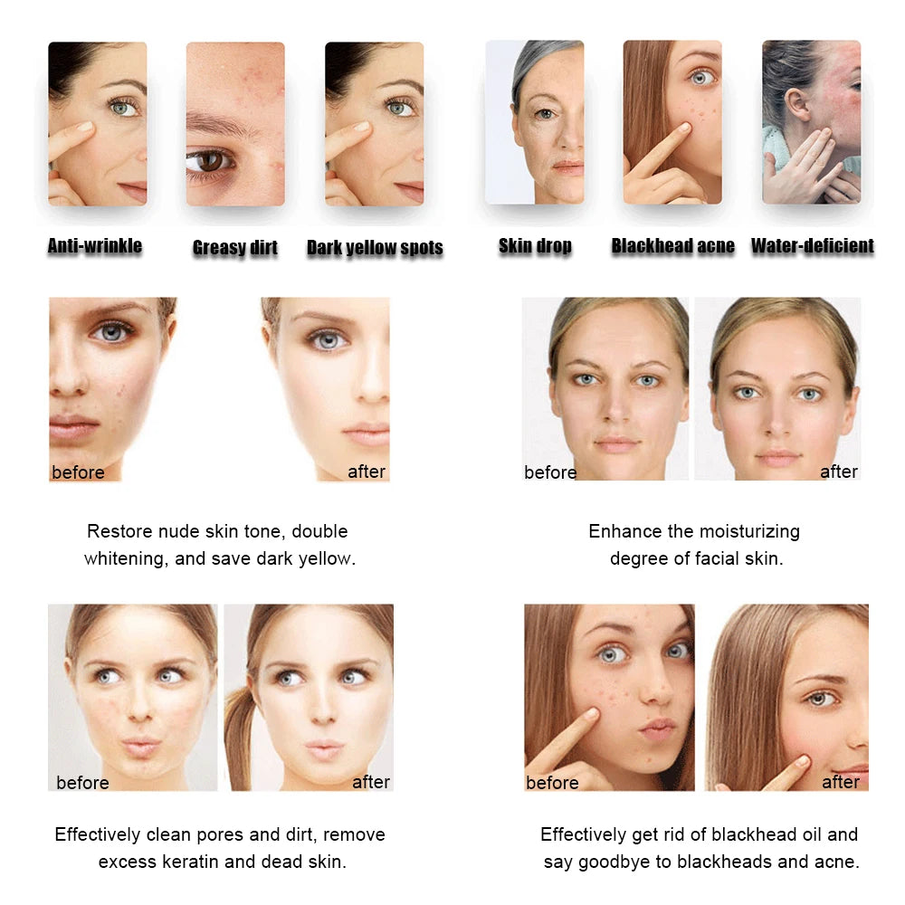 Máquina Hidrodermabrasão Facial H2O2 - Limpeza Profunda com Oxigénio e Peeling Aquático