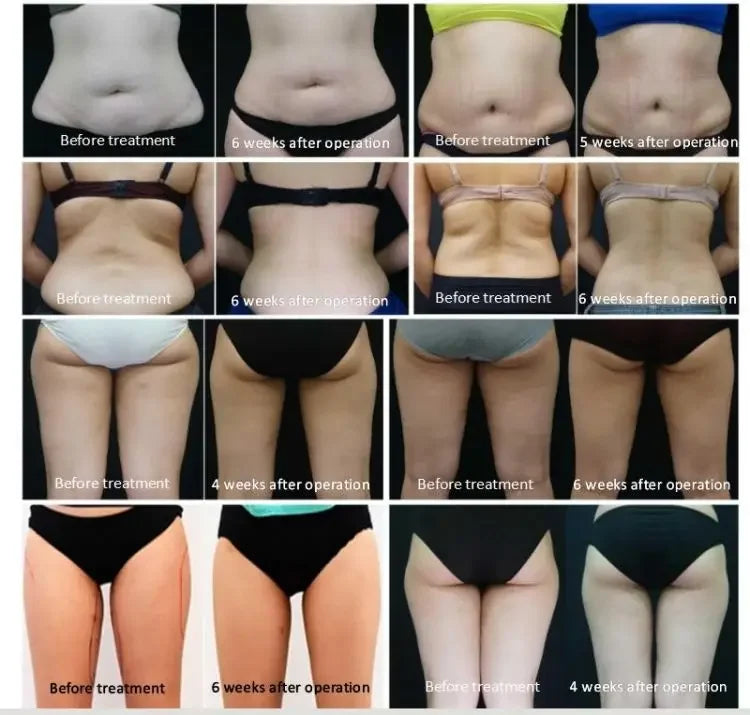 Máquina Criolipolise EMS com Estimulação Muscular - Equipamento Profissional Modelação Corporal
