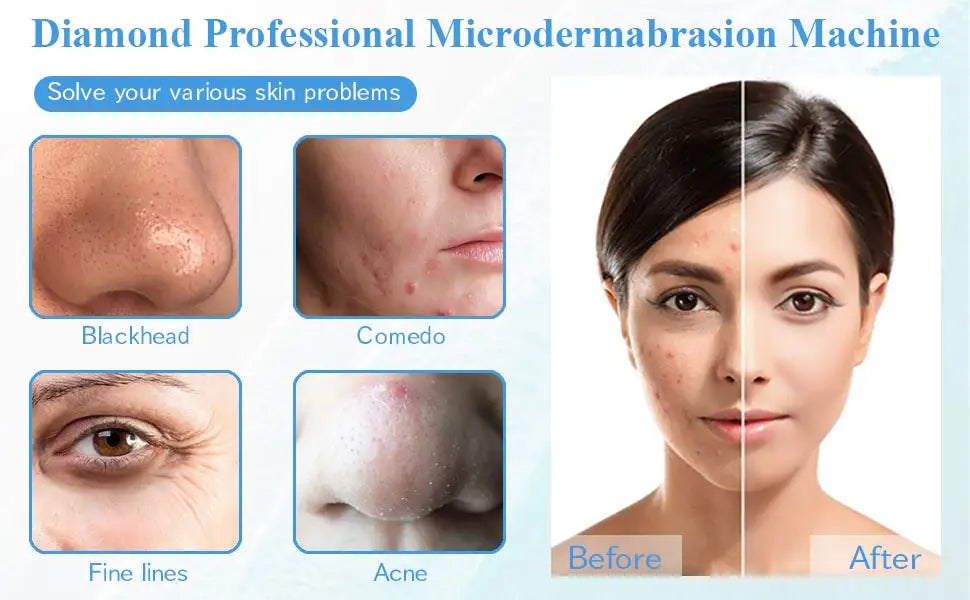 Máquina Microdermoabrasão Diamante Beauty Star - 65-68cmHg Uso Profissional e Doméstico