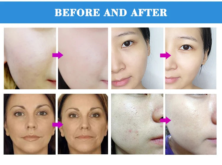 Máquina Microdermoabrasão Diamante Profissional - 65-68cmHg com 9 Pontas para Esfoliação Facial