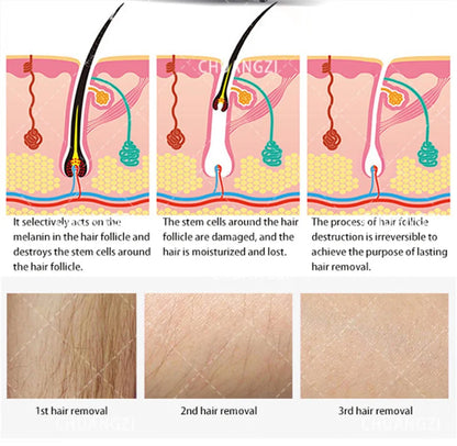 Máquina Laser Diodo 808nm 3 Comprimentos Onda - Depilação Rejuvenescimento Indolor Mulheres