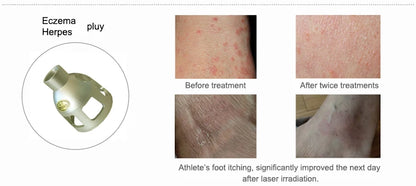 5 in 1 980Nm Diode Laser Physiotherapy Vascular Remove Professional Nail Fungus Laser 980Nm Machine Pain Relief 980Nm Machine