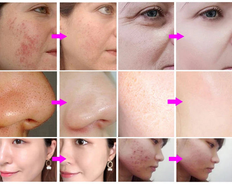 Máquina Hidrodermabrasão 15 em 1 - Oxigénio CO2 Bolhas Hydra Dermabrasão Facial Beleza