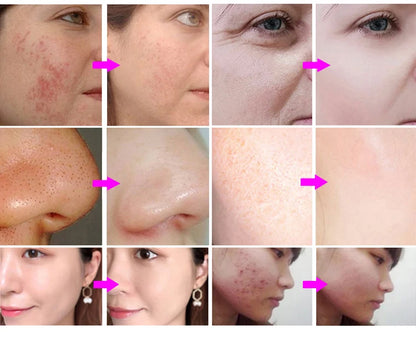 Máquina Hidrodermabrasão 15 em 1 - Oxigénio CO2 Bolhas Hydra Dermabrasão Facial Beleza