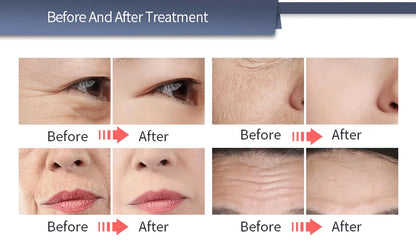 Máquina Profissional de Estimulação Elétrica Facial EMRF EMS RF Lifting Facial PEFACE Sculpt Pads Massageador Equipamento
