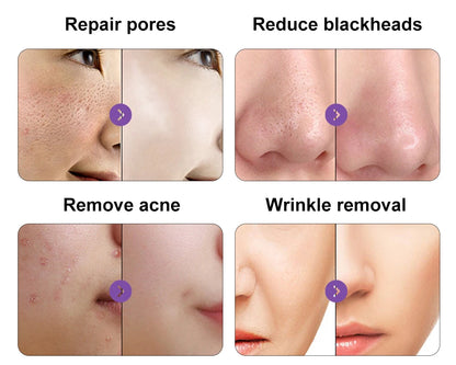 Máquina Hidrodermabrasão Facial H2O2 - Limpeza Profunda com Oxigénio e Peeling Aquático