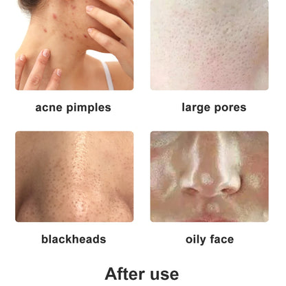 Máquina Microdermoabrasão Facial Beemyi - Pontas Diamante para Rejuvenescimento e Esfoliação