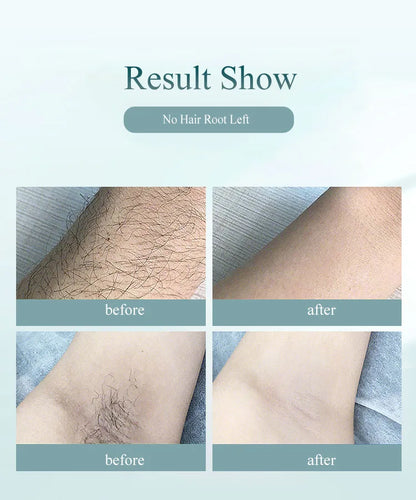 Depilador IPL Profissional Permanente - Remoção Pelos Corpo Inteiro Casa Mulheres 900.000 Flashes