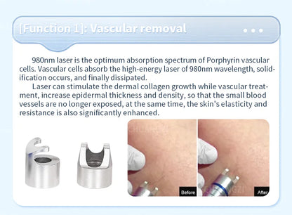 980Nm Laser Diode Vascular Spider Varicose Vein Removal Machine Treatment Fungi Physiotherapy For Nail Lipolisi Commercial Salon