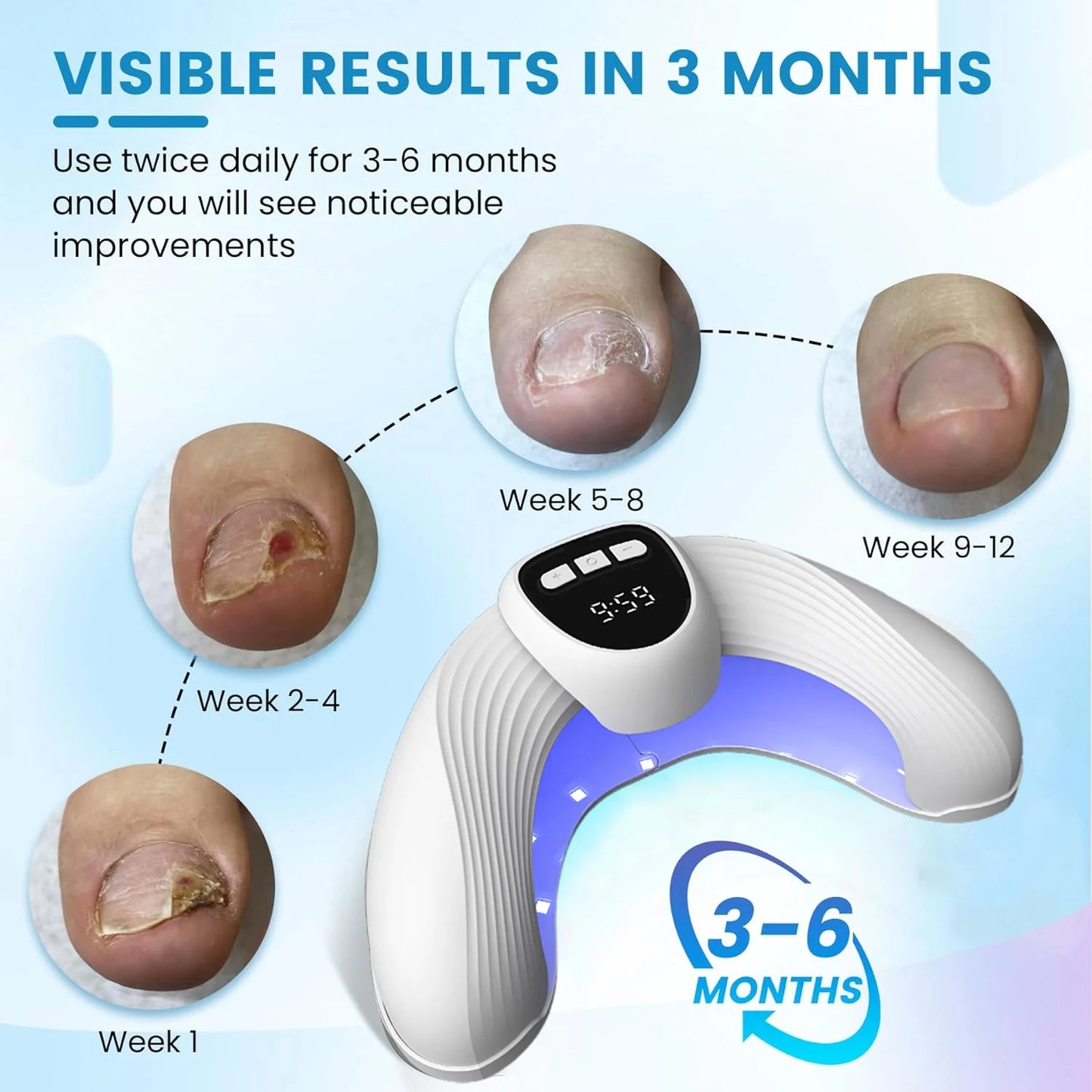 Fungal Nail Laser Treatment Device - Anti Fungus for Toenail & Fingernail Infections Onychomycosis, Paronychia, Ingrown Toenail