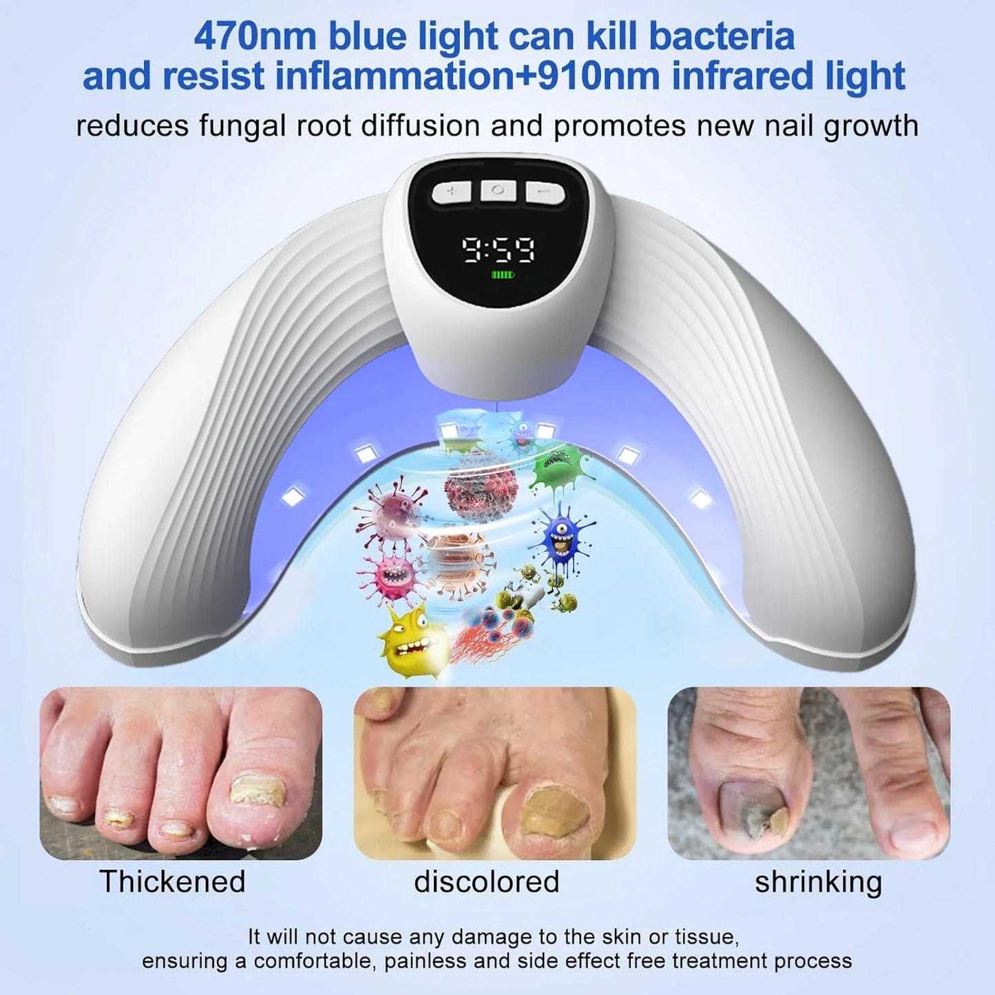 Fungal Nail Laser Treatment Device - Anti Fungus for Toenail & Fingernail Infections Onychomycosis, Paronychia, Ingrown Toenail