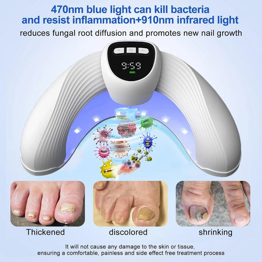 Fungal Nail Laser Treatment Device - Anti Fungus for Toenail & Fingernail Infections Onychomycosis, Paronychia, Ingrown Toenail