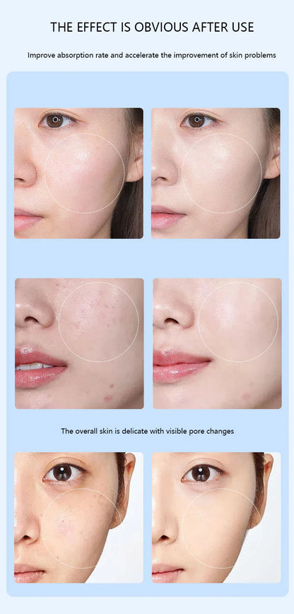 Caneta Nano Microagulhamento Facial - Dispositivo Cuidados Pele LED Fóton Vibração Massageador Mesogun Aplicador Sérum
