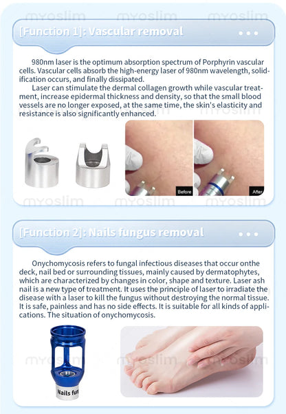 BEST 5 in 1 980nm Diode Laser Vascular Removal Machine Remove Spider Veins 980 Diode Laser Blood Vessels Removal Nail Fungus