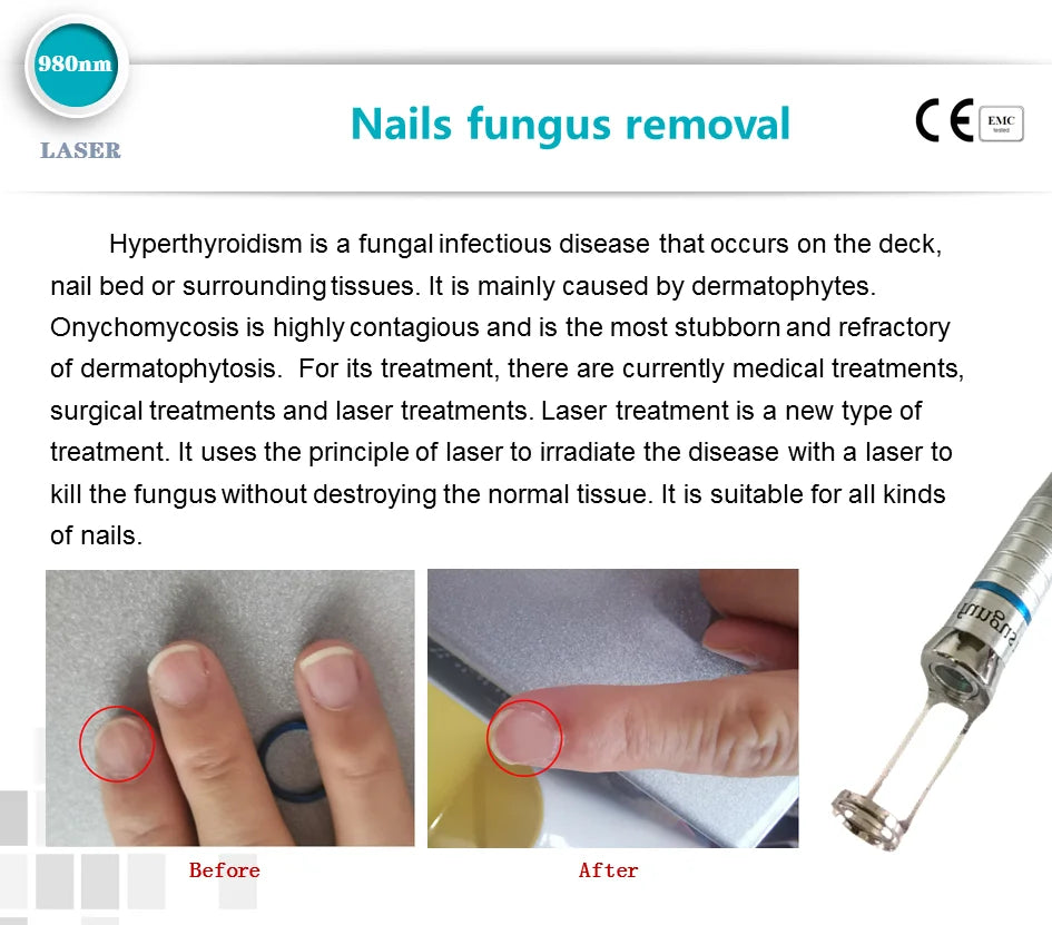 5 In 1 980nm Diode Laser Machine Nail Fungus Treatment Spider Veins Vascular Removal Skin Rejuvenation Beauty Device