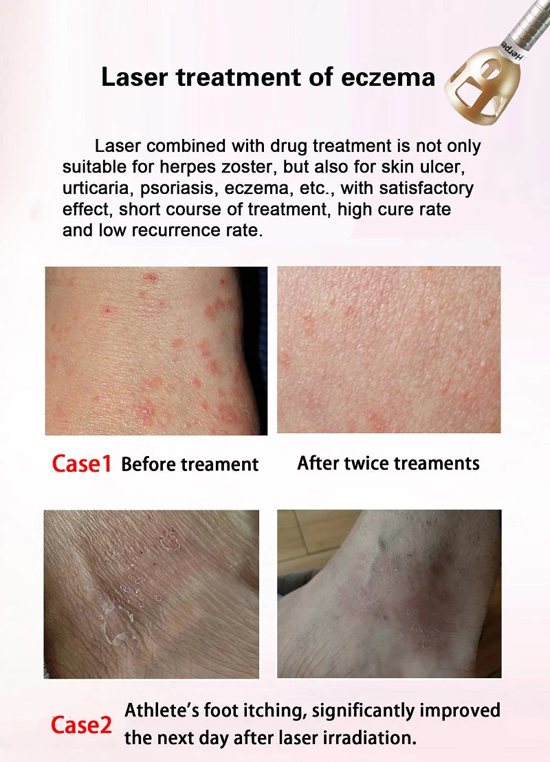 980Nm Laser Diode Vascular Spider Varicose Vein Removal Machine Treatment Fungi Physiotherapy For Nail Lipolisi Commercial Salon