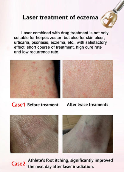 980Nm Laser Diode Vascular Spider Varicose Vein Removal Machine Treatment Fungi Physiotherapy For Nail Lipolisi Commercial Salon