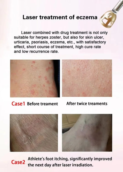 Newest 6 in 1 980nm Diode Laser Therapy Machine Vascular Removal Spider Vein Removal Machine Nail Fungus Laser Onychomycosis