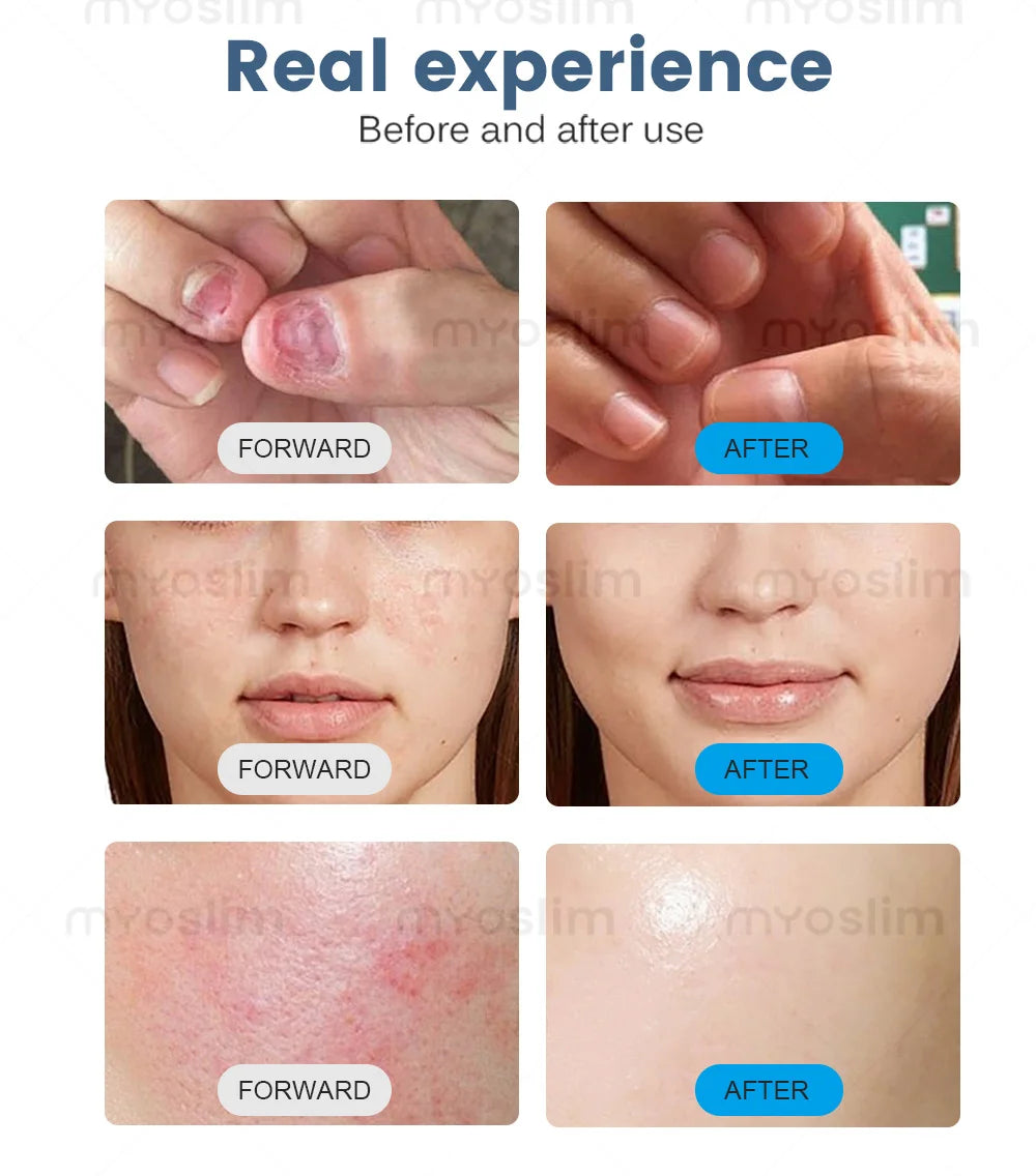 30W 5 in 1 980nm Diode Laser Blood Vessels Removal Nail Fungus 980 Diode Laser Vascular Removal Machine Remove Spider Veins
