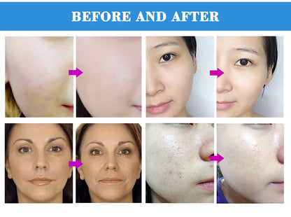 Máquina Microdermoabrasão Diamante Profissional - 65-68cmHg com 9 Pontas para Esfoliação Facial