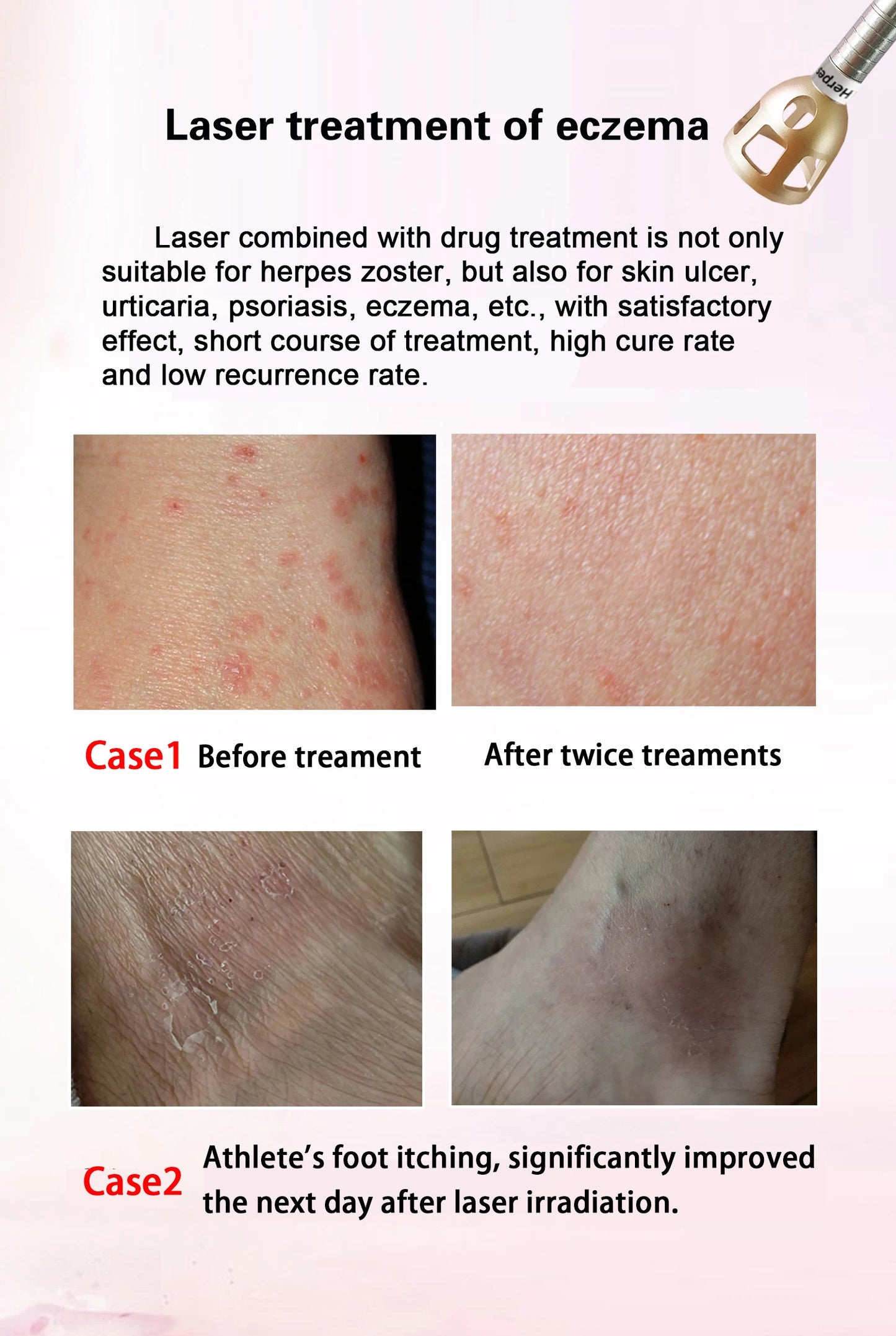5 In 1 980nm Diode Laser Machine Nail Fungus Treatment Spider Veins Vascular Removal Skin Rejuvenation Beauty Device