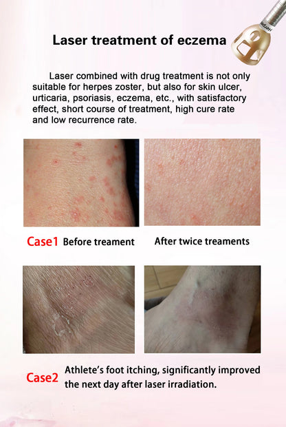 5 In 1 980nm Diode Laser Machine Nail Fungus Treatment Spider Veins Vascular Removal Skin Rejuvenation Beauty Device