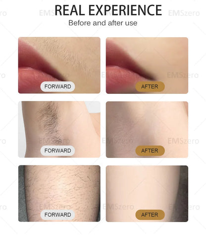 Máquina Laser Diodo Profissional 808nm/755nm/1064nm - Depilação Permanente Indolor Segura Eficaz